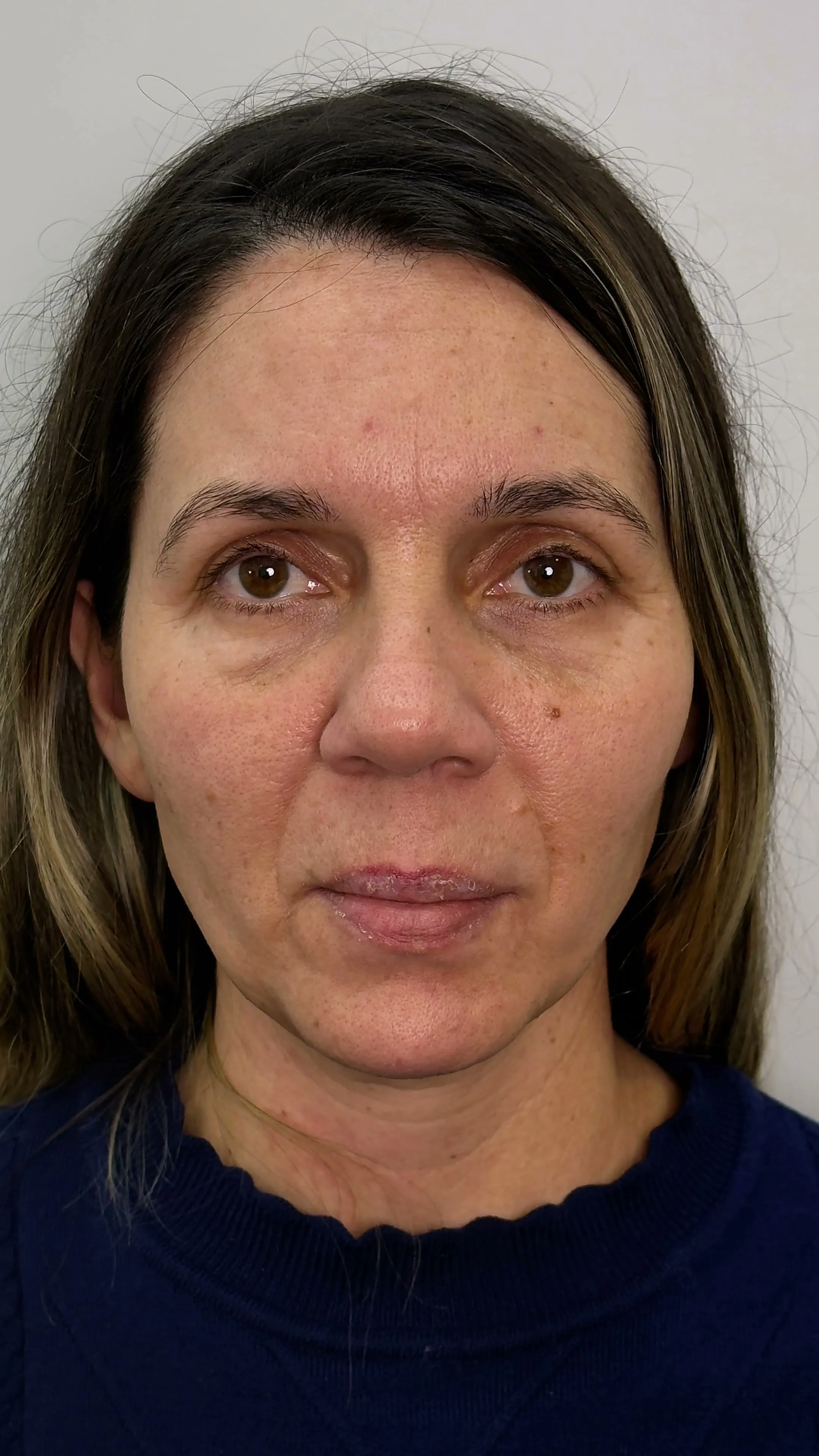 Antes Deep Plane Facelift Buenos Aires caso 2