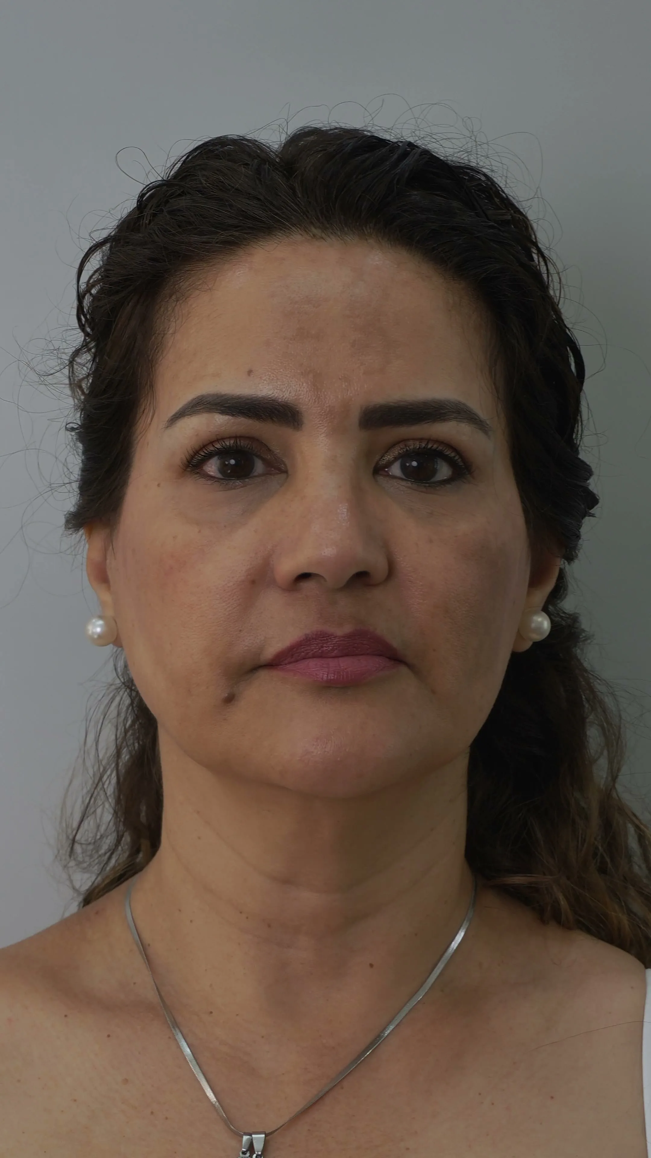 Antes Deep Plane Facelift Buenos Aires caso 5