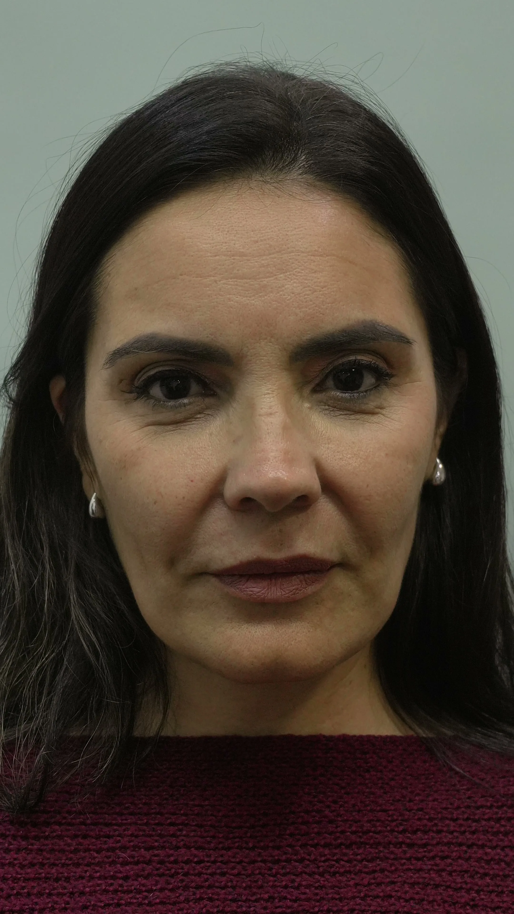 Antes Deep Plane Facelift Buenos Aires caso 6